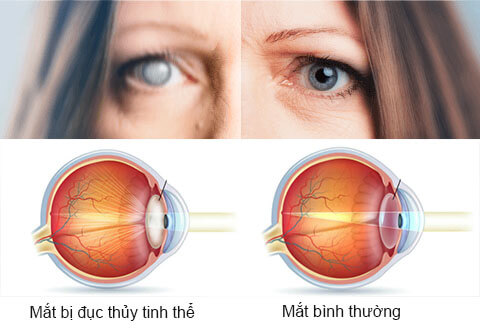 mắt bị đục thủy tinh thể